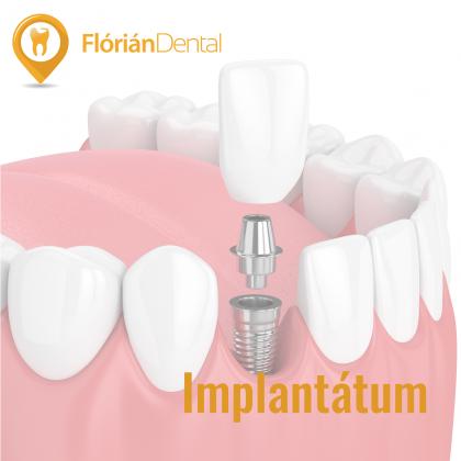 Implantológia